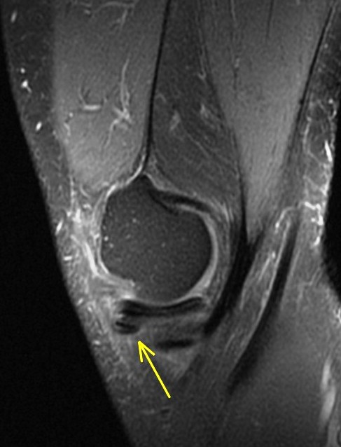 Figure 2 for case Unstable displaced medial meniscus flap tear ( RID2775 )